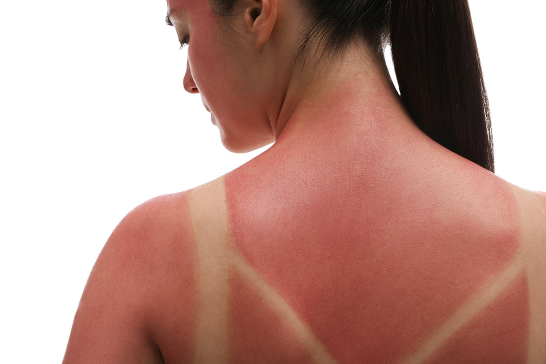 sunburn