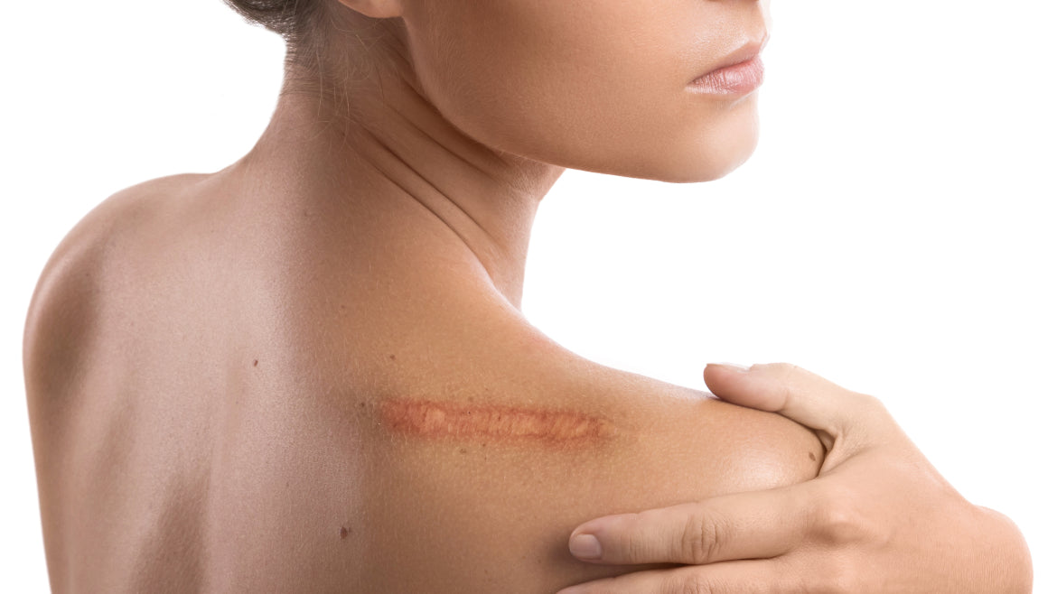 Skin Burn Treatment: Simple Steps to Heal Your Skin Fast
